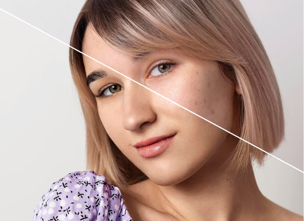 laser treatment for pigmentation in delhi