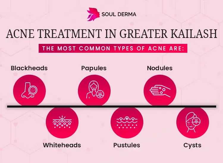 Acne Treatment in Greater Kailash: At Soul Derma Clinic, the most common types of acne treated include blackheads, whiteheads, papules, pustules, nodules, and cysts.