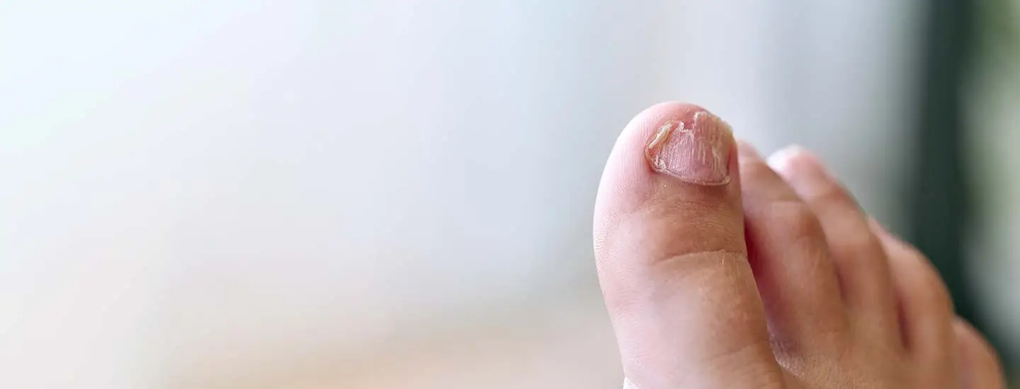 Ingrown Toenails