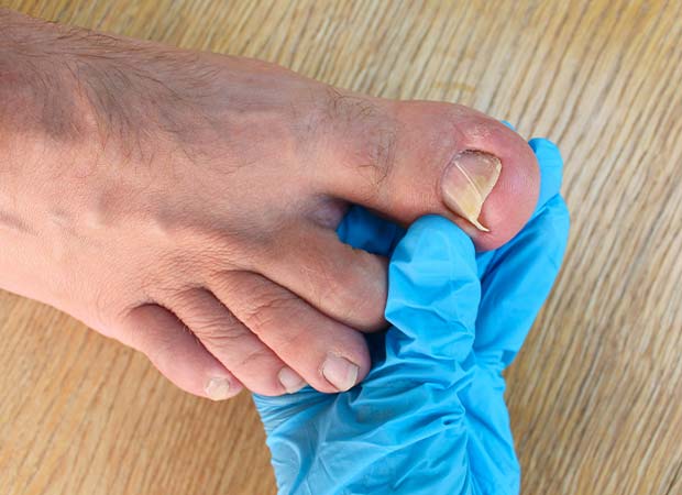 Ingrown Toenail Treatment in Greater Kailash : When the edges or corners of your nails grow into the skin next to the nail, you have ingrown toenails.