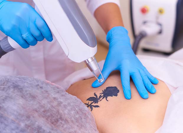 Laser Tattoo Removal in South Delhi : if you are considering getting rid of an old tattoo or are regretting one, laser tattoo removal at Soul Derma clinic has got you covered.