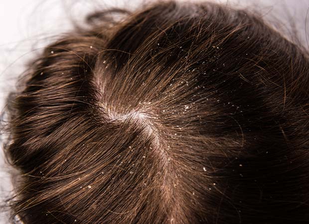 Dandruff Treatment in Greater Kailash: Dandruff is a  common skin condition wherein dead scalp cells form whitish, greyish flakes and fall off.