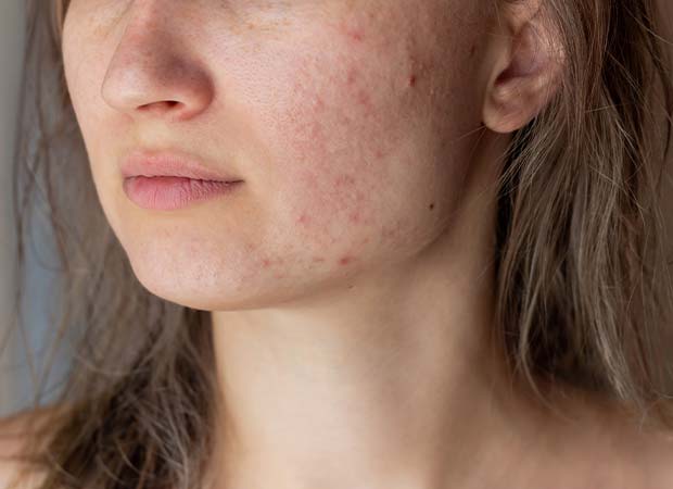 Acne Treatment in Greater Kailash: Acne can occur on any part of the body but most commonly occur on the face, chest, and back.