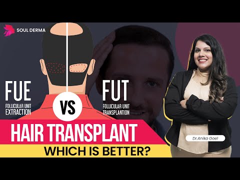 FUE vs FUT Hair Transplant Techniques | Best Hair Transplant | Hair Transplant Cost in South Delhi