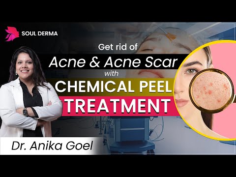 Chemical Peeling Treatment for Acne & Acne scars | Acne Treatment in Greater kailash | Soul Derma