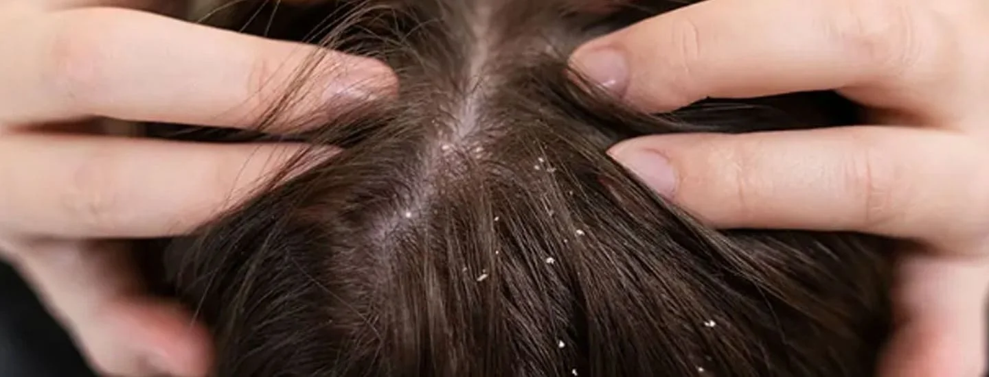 Best Hair Doctor in Delhi – Soul Derma Clinic